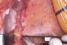 Illustration 36 for Mastering Valgus Total Knee Replacement: Techniques & Pitfalls