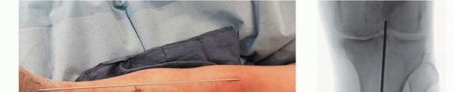 Illustration 18 for Optimizing Intramedullary Nailing for Tibial Shaft Fractures