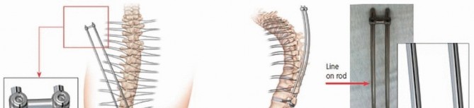 Illustration 24 for Duchenne Muscular Dystrophy: Is Spinal Fusion the Answer?