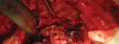 Illustration 27 for Navigating Early THA for Fractures of the Acetabulum