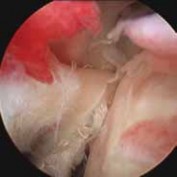 Illustration 4 for Resolve Long Head Biceps Pain: Advanced Arthroscopic Treatment