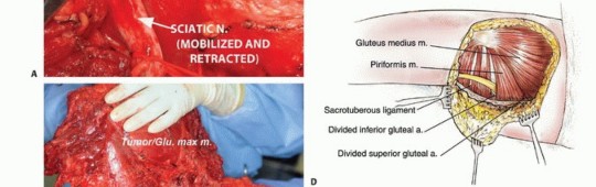 Illustration 16 for Beyond Hemipelvectomy: Preservation of the Sciatic in Buttock Surgery