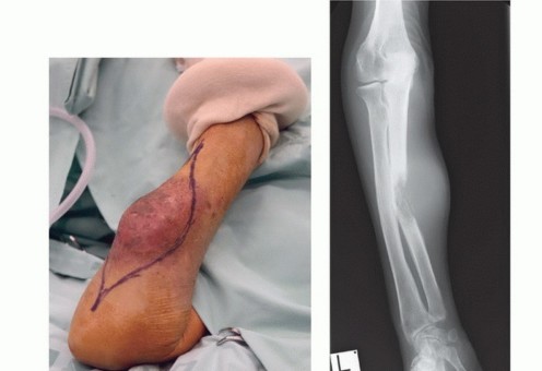 Illustration 3 for Above-Elbow & Below-Elbow Amputations: When & Why They're Needed