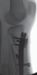 Illustration 34 for Optimal Nailing of the Tibia: Techniques for Challenging Fractures