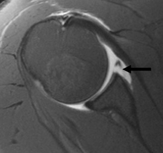 Illustration of glenoid bone loss - Dr. Mohammed Hutaif