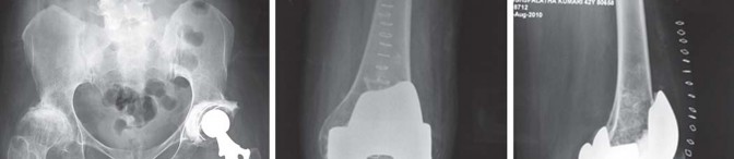 Illustration 45 for Total Hip Arthroplasty: Restoring Mobility in Juvenile Idiopathic Arthritis