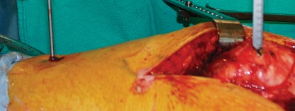 Illustration 19 for Cementless Femoral Stems: Master Indications & Avoid Pitfalls