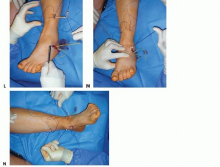 Illustration 23 for How Achilles Tendon Lengthening Fixes Equinocavovarus Foot