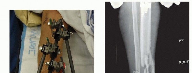 Illustration 43 for Tibia External Fixation: See How Pins Are Placed for Healing