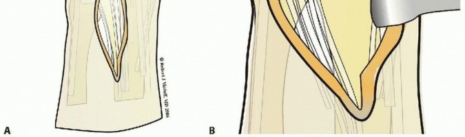 Illustration 17 for Fragment-Specific Fixation: Restore Carpal Facet Horizon