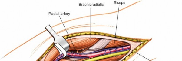 Illustration 82 for Mastering Elbow Approaches: Applied Surgical Anatomy for Precision