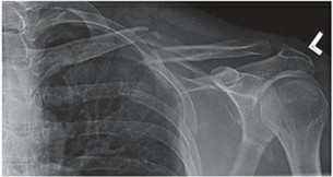 Medial Clavicular Fragment Fractures: Risks, Symptoms, & Recovery