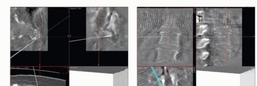 Illustration 52 for Sacral Tumor Surgery: Safeguarding Bowel & Bladder Control