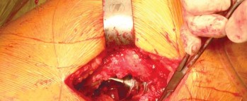 Illustration 59 for Exploring the Ambulatory Surgical Setting for Total Hip Replacement