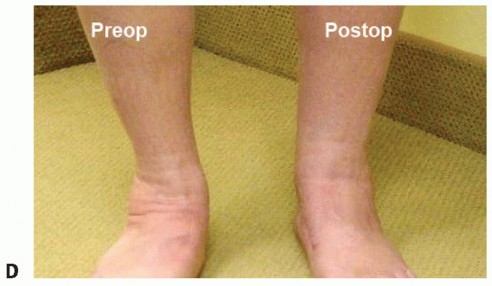 Illustration 28 for Lateral Column Lengthening: Relieve Flatfoot Pain & Correct Deformity