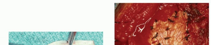 Illustration 17 for Subscapularis & Teres Rotator Cuff Repair: Advanced Techniques