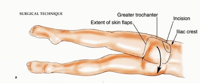 Illustration 7 for Beyond Hemipelvectomy: Preservation of the Sciatic in Buttock Surgery
