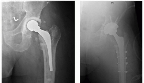 Illustration 23 for Extended Trochanteric Osteotomy: How et al Extended Revision THA Solutions