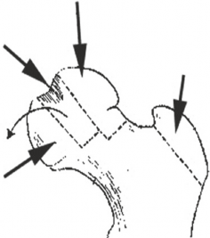 Illustration 7 for Conservative Head Reduction Osteotomy: Restoring Young Hip Function