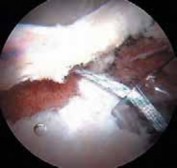 Illustration 19 for Resolving Femoral Head Neck Impingement: Arthroscopic FAI Solutions