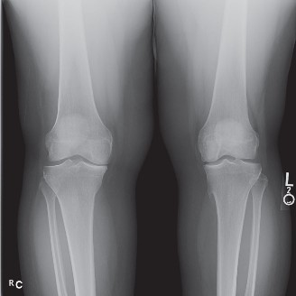 Illustration 2 for Lachman and Anterior: 4 Cases Where You Miss the Diagnosis