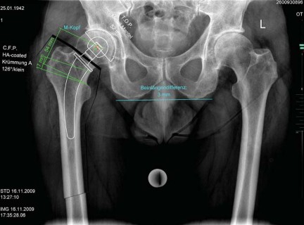 Illustration 9 for Collum Femoris Preserving: Achieve Better Primary Hip Outcomes