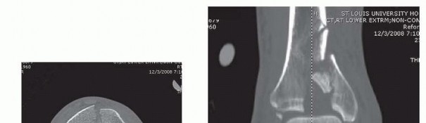 Illustration 18 for Tibia External Fixation: See How Pins Are Placed for Healing