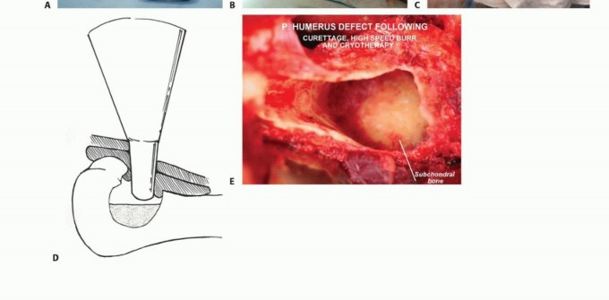 Illustration 9 for Avoid Major Surgery: Bone Tumor Treatment with Liquid Nitrogen Pour