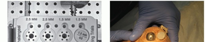 Illustration 70 for End Articular Cartilage Loss: Arthrosurface HemiCAP Resurfacing