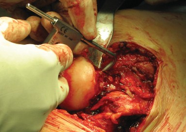 Illustration 40 for Figure Hip Resurfacing: Who Benefits and Who Should Avoid It?