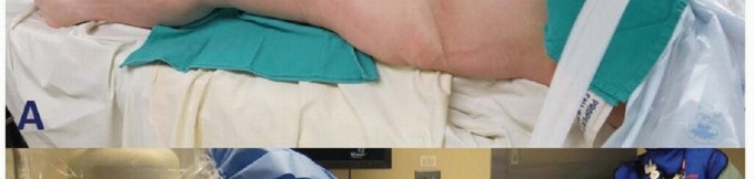 Illustration 12 for Mastering Fixation of Periprosthetic Fractures of the Femur