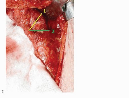 Illustration 37 for Special THA Techniques for Severe Deformities Around the Hip