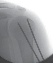 Illustration 14 for Mastering Pediatric Shoulder Fractures: Clinical Insights