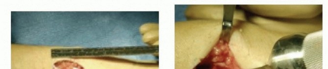 Illustration 19 for Distal Radius Fixation: Precision Through Lister's Tubercle