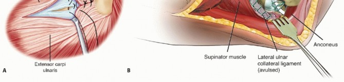 Illustration 21 for Radial Head Arthroplasty: Restoring Elbow Function & Stability