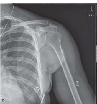 Illustration 2 for Orthopedic Oncology Cases: Avoid Misdiagnosis of Tumor Mimickers