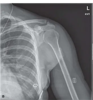 صورة توضيحية لـ التهاب العضلات المتكلس: دليل شامل للتشخيص والعلاج والوقاية مع الأستاذ الدكتور محمد هطيف