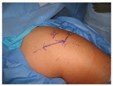 Illustration 3 for Recreate Hip Biomechanics: Modular Stems for Modular Solutions