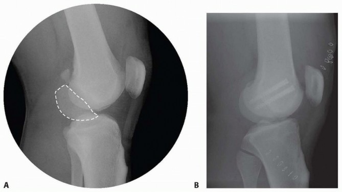 Illustration 30 for Repairing Distal Femur Fractures: Open Reduction & Internal Fixation