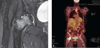 Illustration 2 for Optimizing the Management of Difficult Metastatic Lesions