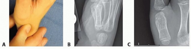 Illustration of clinodactyly surgical treatment - Dr. Mohammed Hutaif
