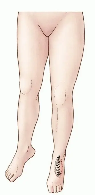 بتر الساق تحت الركبة: دليل شامل للتعافي الأمثل واستعادة الوظيفة مع الأستاذ الدكتور محمد هطيف