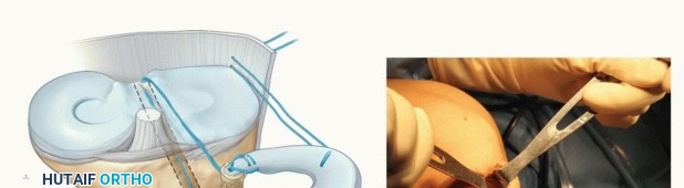 Illustration 26 for Symptomatic Knee? Meniscal Transplant for Anterior & Posterior Horns