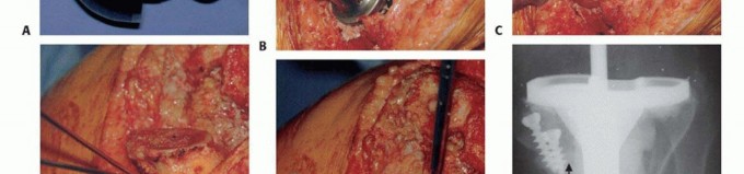 Illustration 13 for Bone Loss Bone Grafting for Challenging Tibial Defects