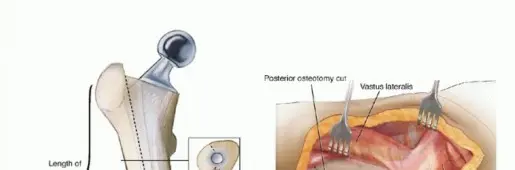 مراجعة استبدال مفصل الورك الكلي: دقة إزالة المكونات الثابتة والحفاظ على العظم مع الأستاذ الدكتور محمد هطيف