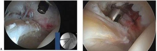 Illustration 116 for Precision Hip Arthroscopy: Unlock Access to the Peripheral Compartment