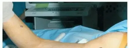 صورة توضيحية لـ جراحة تصحيح تشوهات مفصل الفخذ العلوي: الحل المتكامل لألم الورك المزمن