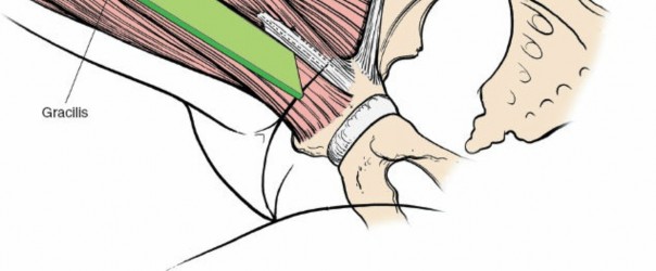 Illustration 215 for Unlocking Every Aspect of the Hip's Surgical Approaches