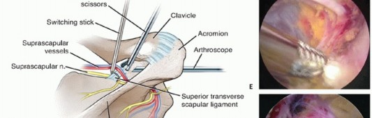 Illustration 10 for Decompressing the Transverse Scapular Ligament for Shoulder Pain Relief