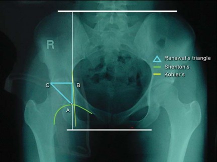 Illustration 14 for Total Hip Replacement for Protrusio: Restore Your Hip Function